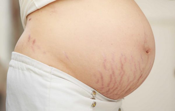 Cách chăm sóc da bụng trong và sau khi mang thai