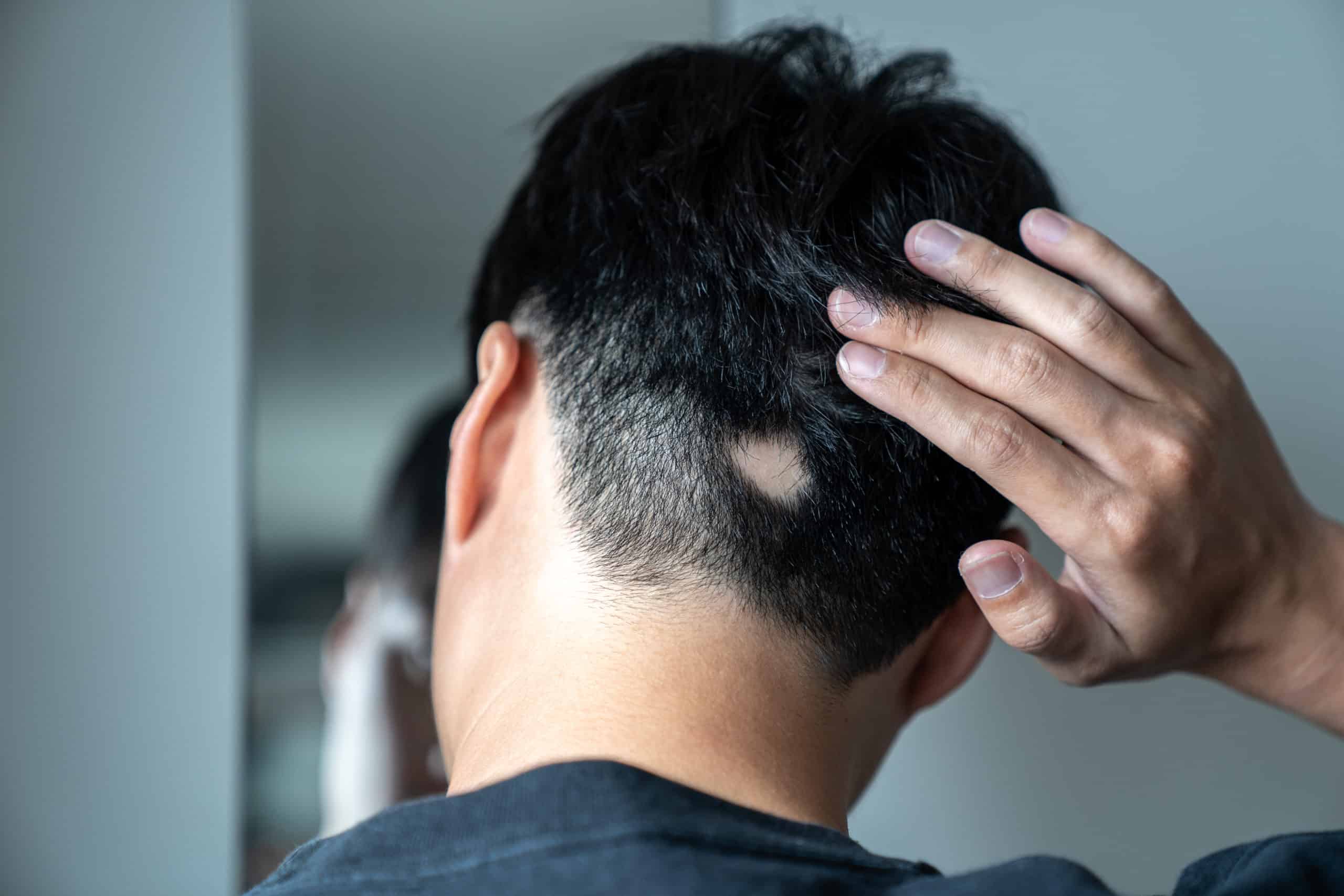 Rụng tóc từng mảng: Nguyên nhân, chẩn đoán và điều trị