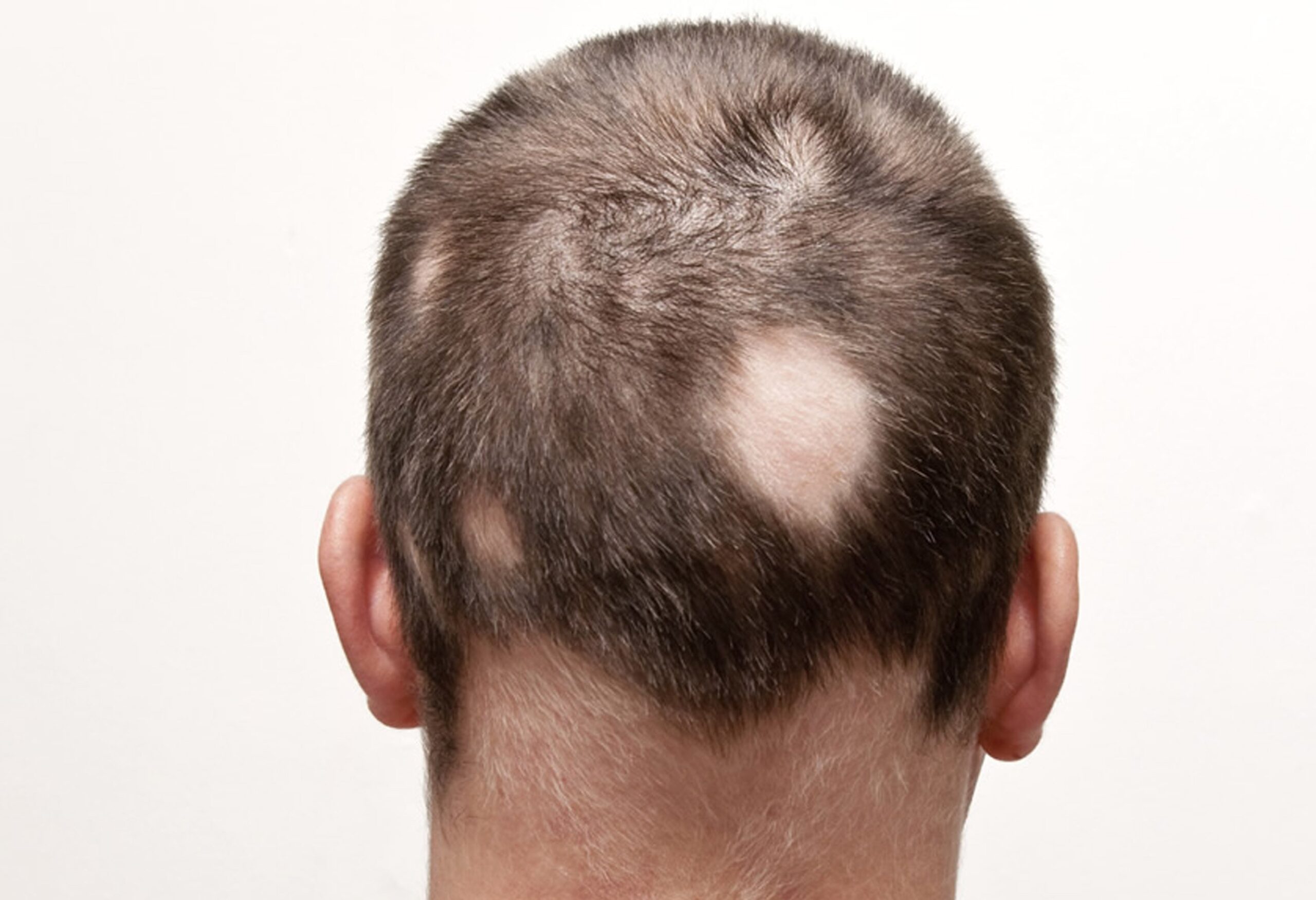 Rụng tóc từng mảng: Nguyên nhân, chẩn đoán và điều trị