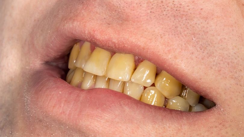 Răng ố vàng